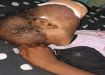 SOS pour Mariama Diallo, une fillette atteinte d’une tumeur très importante sur son visage !!!