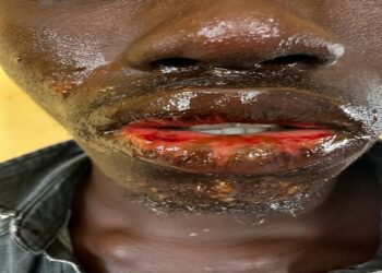 Hôpital Donka :  Les ministre de la pêche et de la santé au chevet des pêcheurs victimes d’une maladie non encore identifiée !!!