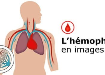 Santé/N’Zérékoré : L&rsquo;hémophilie au centre d’une conférence de Presse !!!