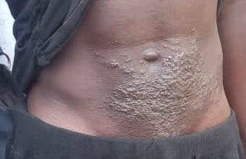 BOFFA : Plusieurs cas de lésions cutanées signalés au Port de Pêche Koukoudé !!!