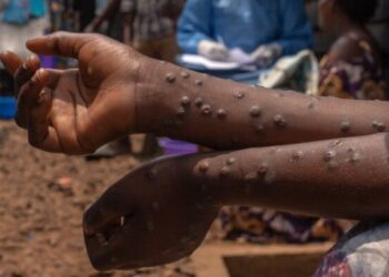 Guinée: Au moins un cas confirmé de Mpox (Médias)!!!