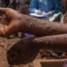 Guinée: Au moins un cas confirmé de Mpox (Médias)!!!