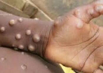 Guinée : L’ANSS fait la situation de l’épidémie de Mpox (Rapport)