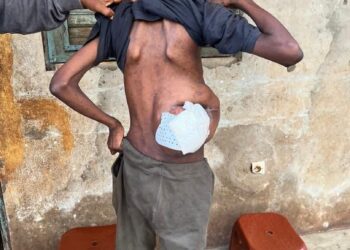 Bantounka 1 : SOS pour Mamadou Dian Sow atteint d’un cancer à ses côtes