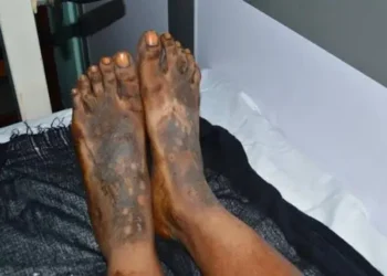 Quand la dépigmentation volontaire devient une urgence silencieuse de santé publique en Guinée (Par Dr Karamo Kaba)